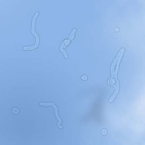 Comprendre Les Myod sopsies Corps Flottants Dans Le Vitreux comprendre-les-myod-sopsies-corps-flottants-dans-le-vitreux